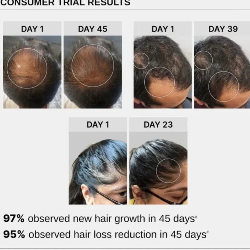 Bare Anatomy Advanced Hair Growth Roll-On Serum | 3% Redensyl + 4% Anagain + 2% Baicapil + 5% Rosemary | Direct Scalp Application for Thicker, Stronger Hair